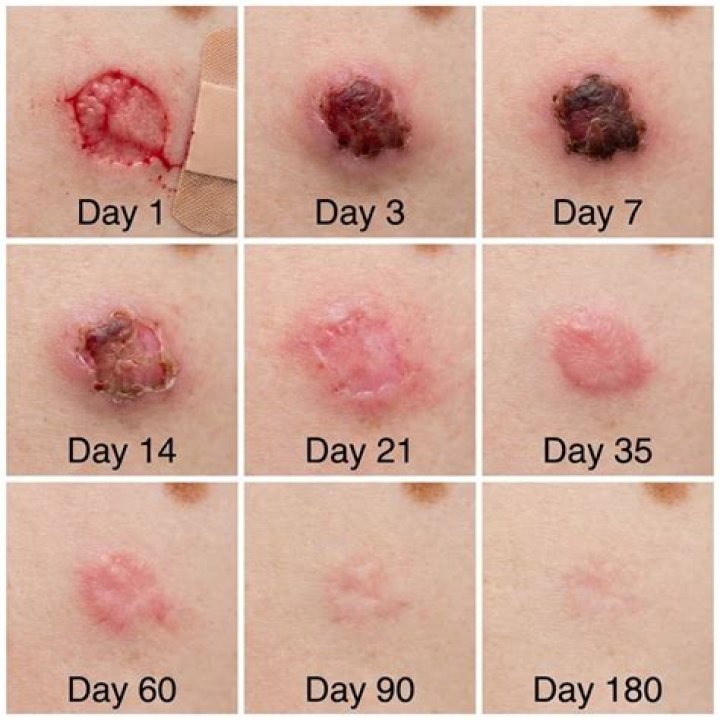 How much does scar excision cost?
