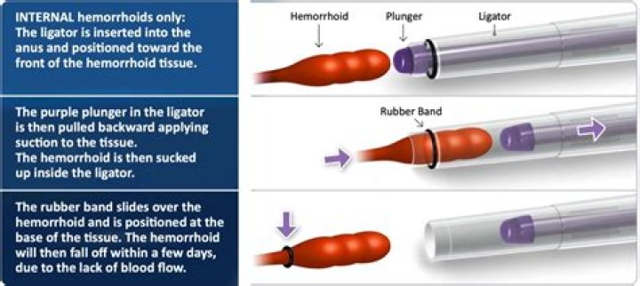 What is suture ligation of hemorrhoids?